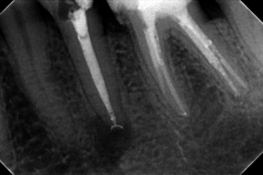 ząb-35-po-leczeniu-kanałowym