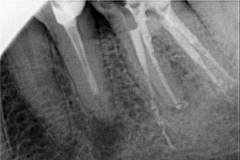 ząb-35niedopełniony-kanał-i-zmiana-wokółkorzenia